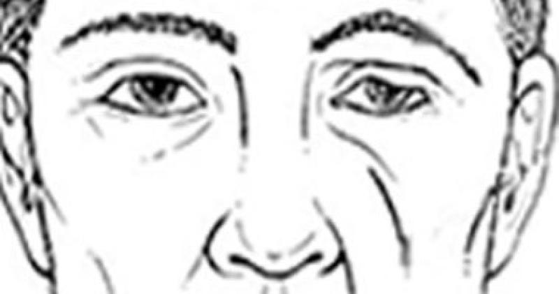 مريض العصب السابع - ارشيفية