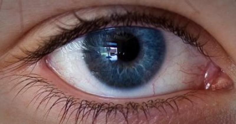 تصحيح البصر