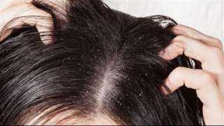 طرق علاج قشرة الشعر الدهنية بالمنزل، وأفضل شامبو لها