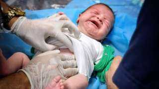 18% من أطفال غزة يعانون سوء تغذية حاد يؤدي للوفاة